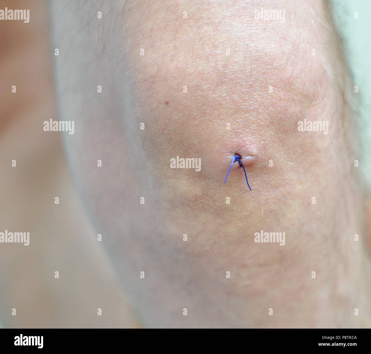 Points sur une chirurgie de la disparition d'un kyste au genou, Close up, suture chirurgicale Banque D'Images