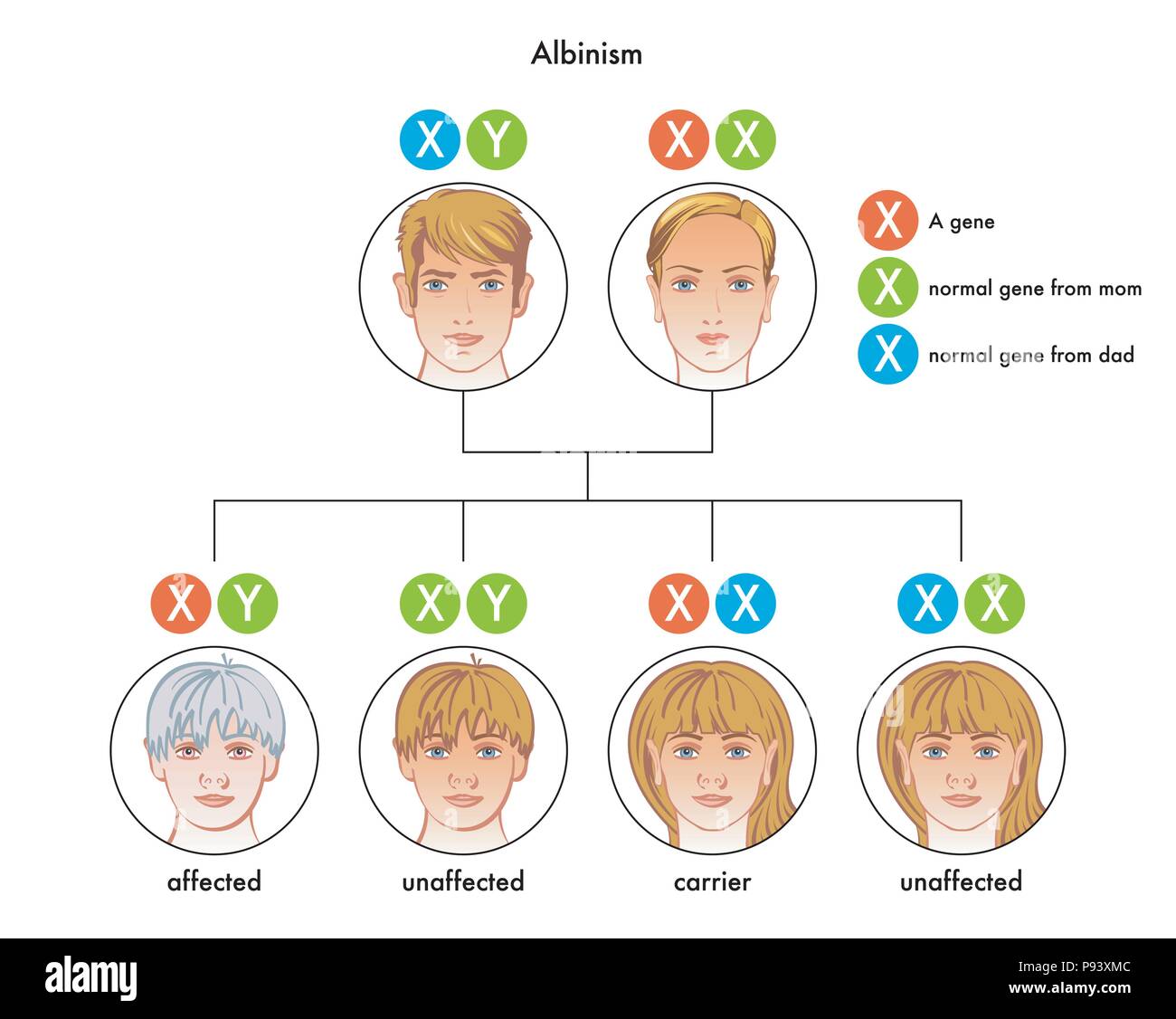 Vector illustration médicale du schéma de l'albinisme Illustration de Vecteur