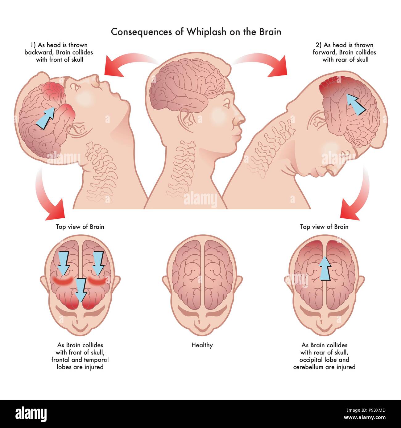Vector illustration médicale des conséquences de blessures sur le cerveau Illustration de Vecteur