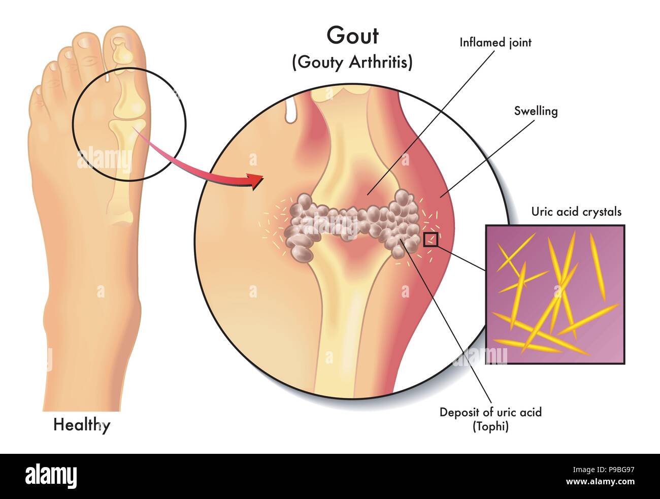 Vector illustration médicale des symptômes de la goutte Illustration de Vecteur