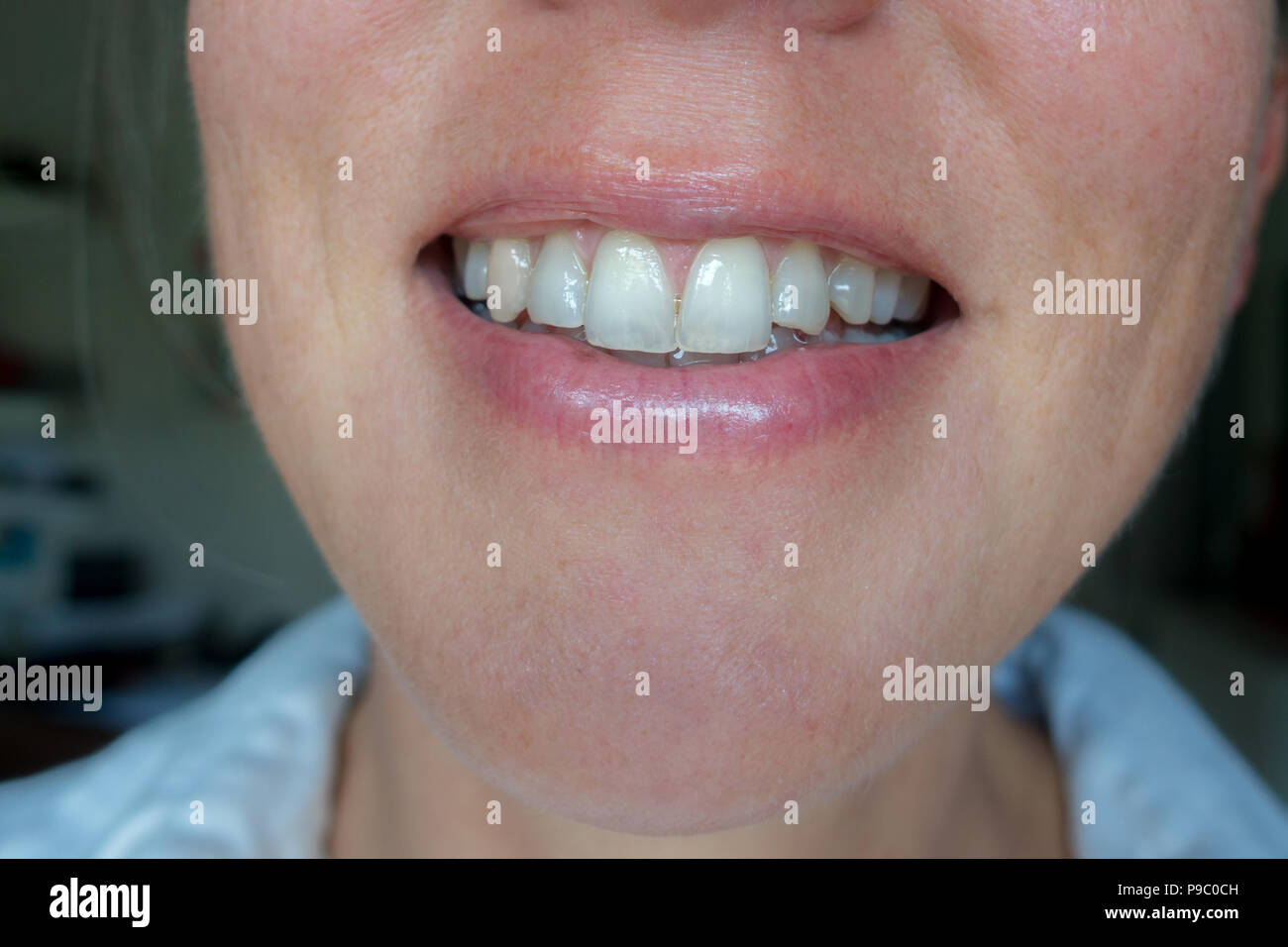 Close up of young woman smiling avec dents translucides et dent ébréchée Banque D'Images