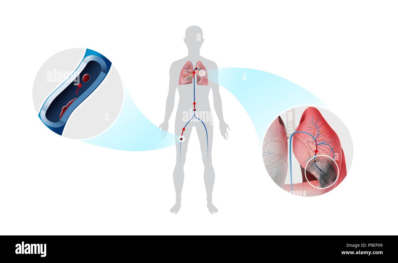 Embolia pulmonar. Banque D'Images