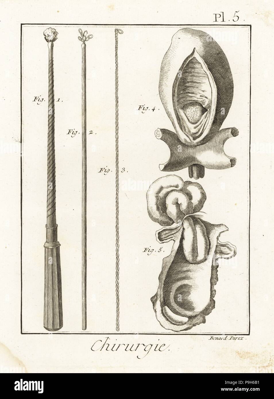 Les instruments de chirurgie pour retirer les corps étrangers de l'oesophage 1-3, pierre enkysté dans la vessie 4 et une hernie dans l'intestin 5. La gravure sur cuivre par Robert Benard de Denis Diderot's Encyclopedia, Pellet, Genève, 1779. Banque D'Images