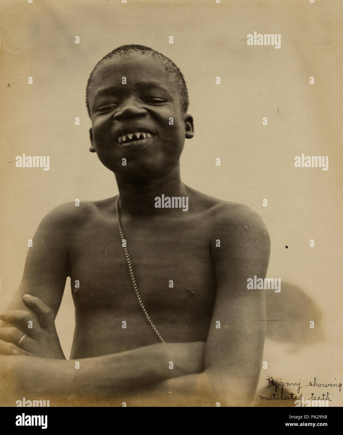 5 "dents mutilées montrant pygmée." (Ota Benga, de pygmées du Congo belge dans le département d'anthropologie à l'Exposition mondiale de 1904) Banque D'Images