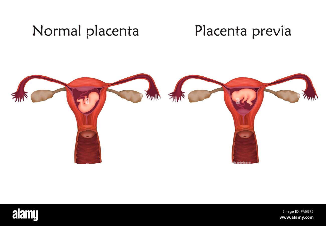 Le previa de placenta et grossesse normale comparaison, illustration. Dans le placenta praevia le placenta couvre l'ouverture du col. Banque D'Images