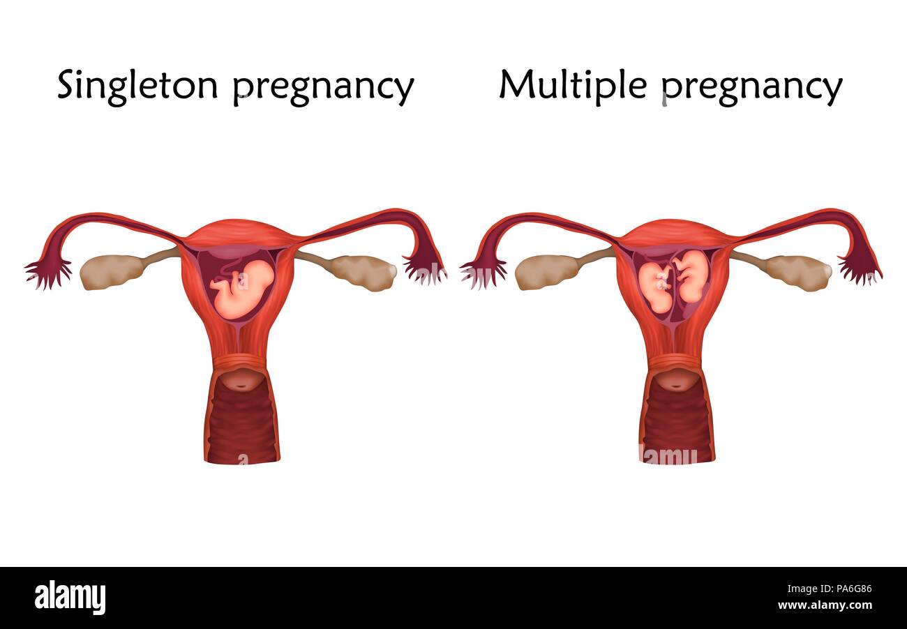 La grossesse de singleton et de multiples comparaisons, illustration Banque D'Images