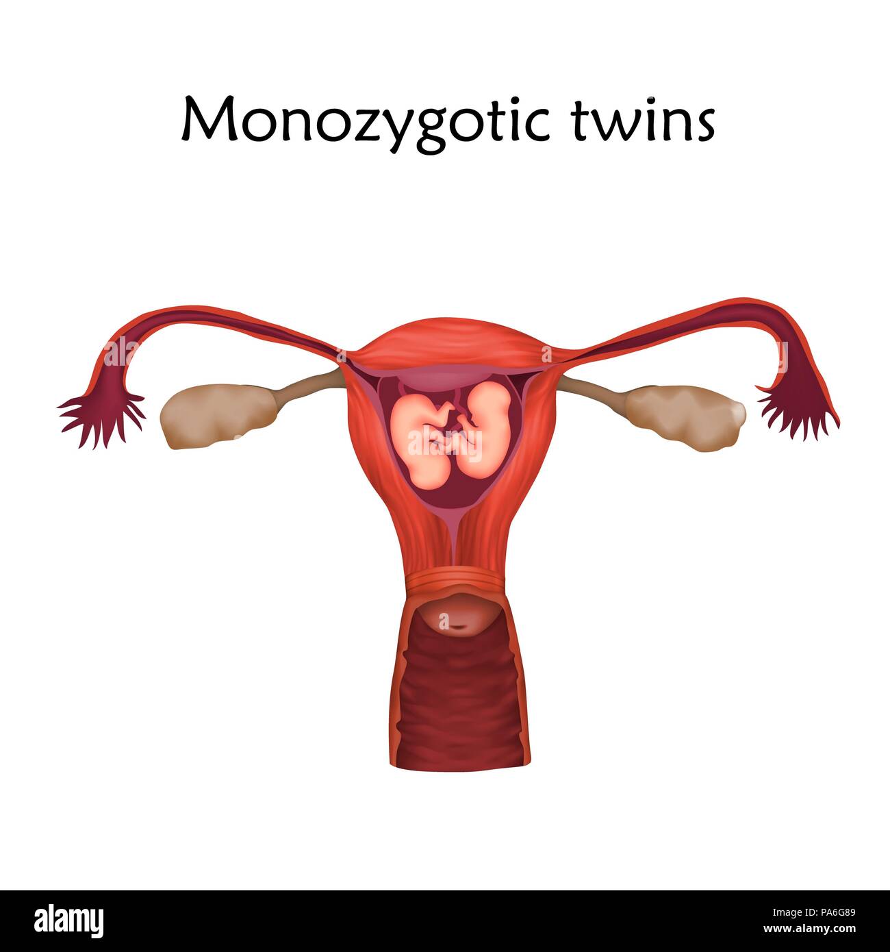 Grossesse multiple, illustration. Les jumeaux Monozygotic dans l'utérus