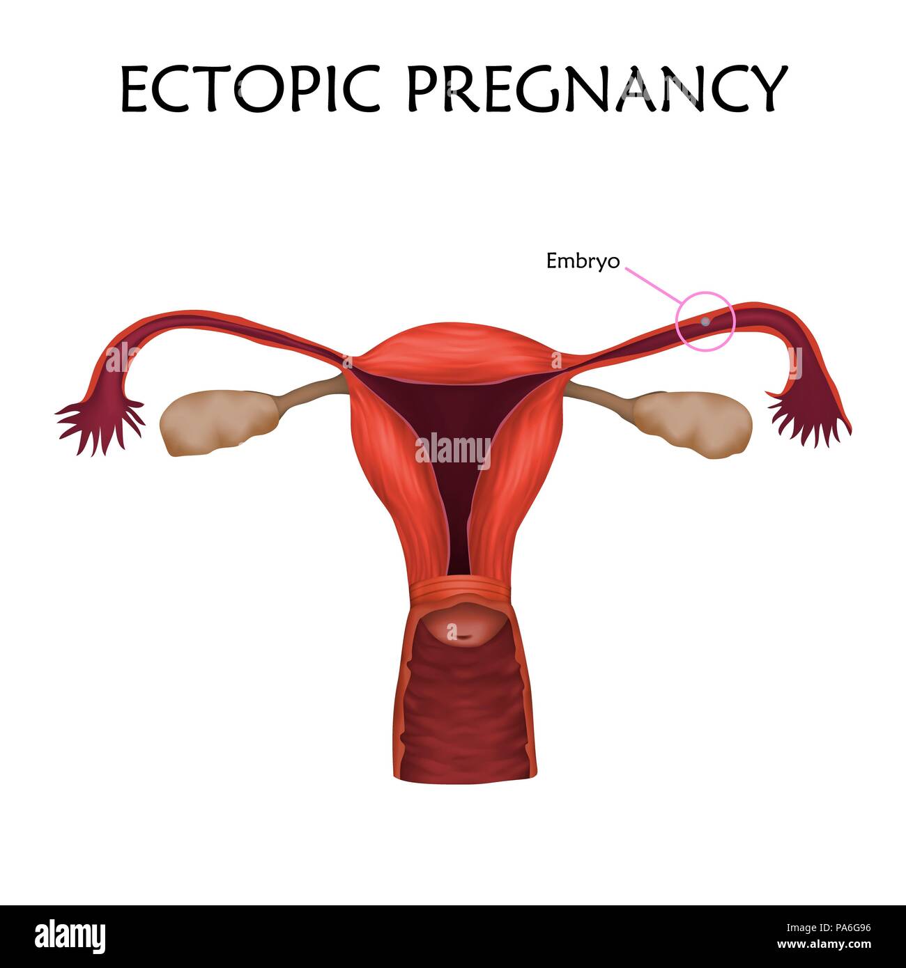 Grossesse extra-utérine, de l'illustration. L'embryon a implanté dans la trompe de Fallope, et non dans l'utérus. Banque D'Images