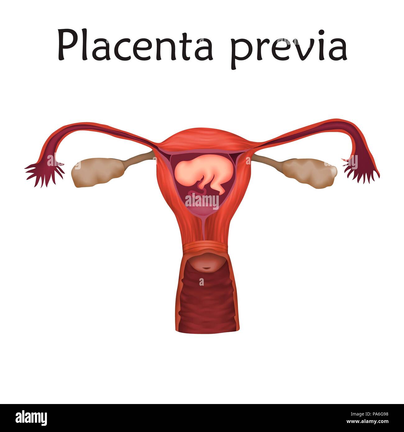 Le previa de placenta, de l'illustration. C'est une condition où le placenta partiellement ou entièrement recouvre le col de l'utérus. Banque D'Images