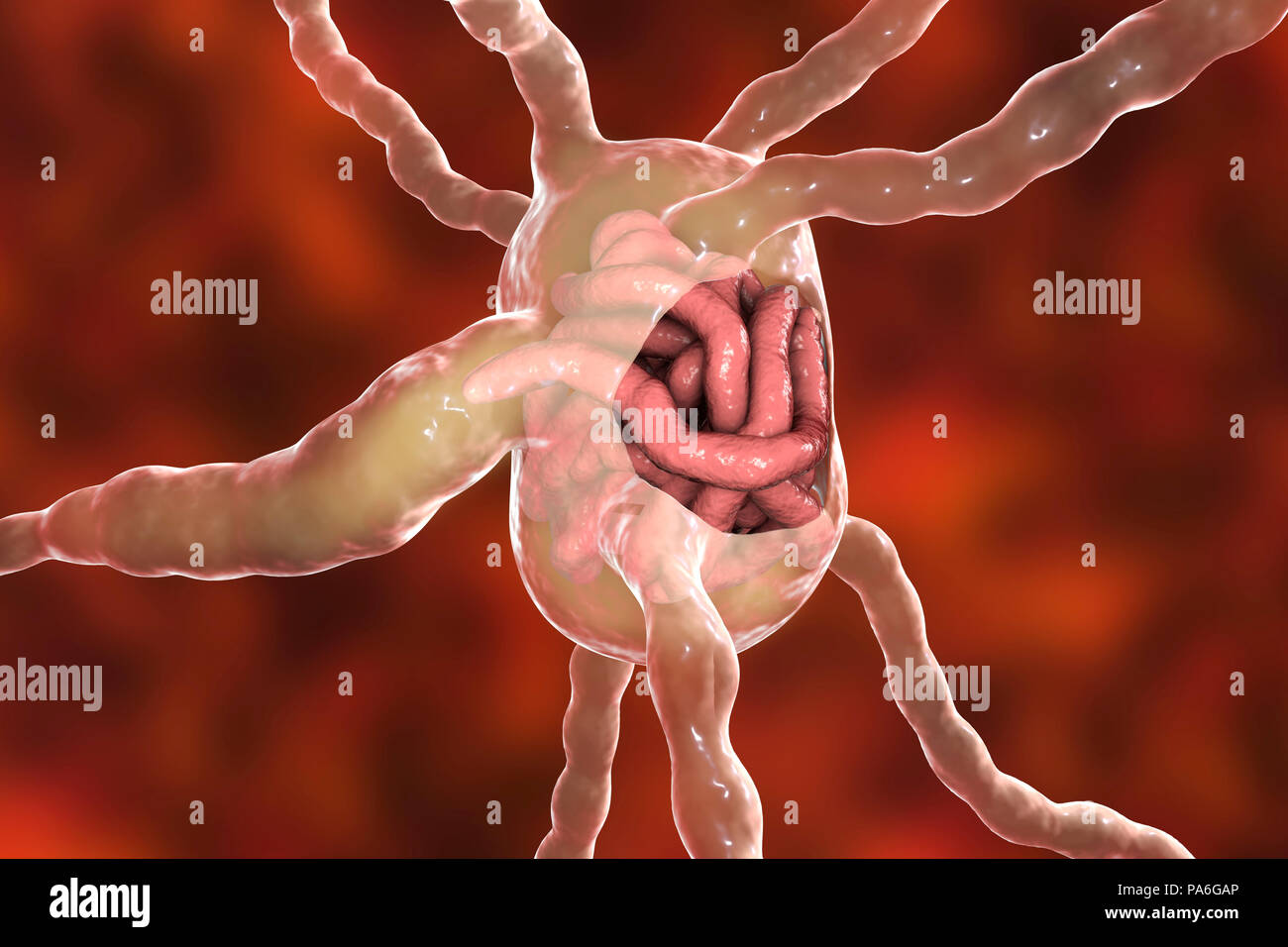 Les filaires avec ganglions vers, illustration. Les filaires sont des vers nématodes parasites transmis en forme larvaire par la piqûre de moustiques, ils causent l'éléphantiasis, également connu sous le nom de la filariose lymphatique. Les larves se développent en vers adultes (macrofilariae) que lodge en bloc et le système lymphatique, qui est affichée dans l'image. Ceci provoque la lymphe à s'accumuler dans les membres, une forme de lymphoedème. L'éléphantiasis est rarement mortel, mais provoque beaucoup de souffrances dans les régions tropicales. Le traitement implique la pharmacothérapie et d'hygiène rigoureuses pour prévenir les infections de la peau. Banque D'Images
