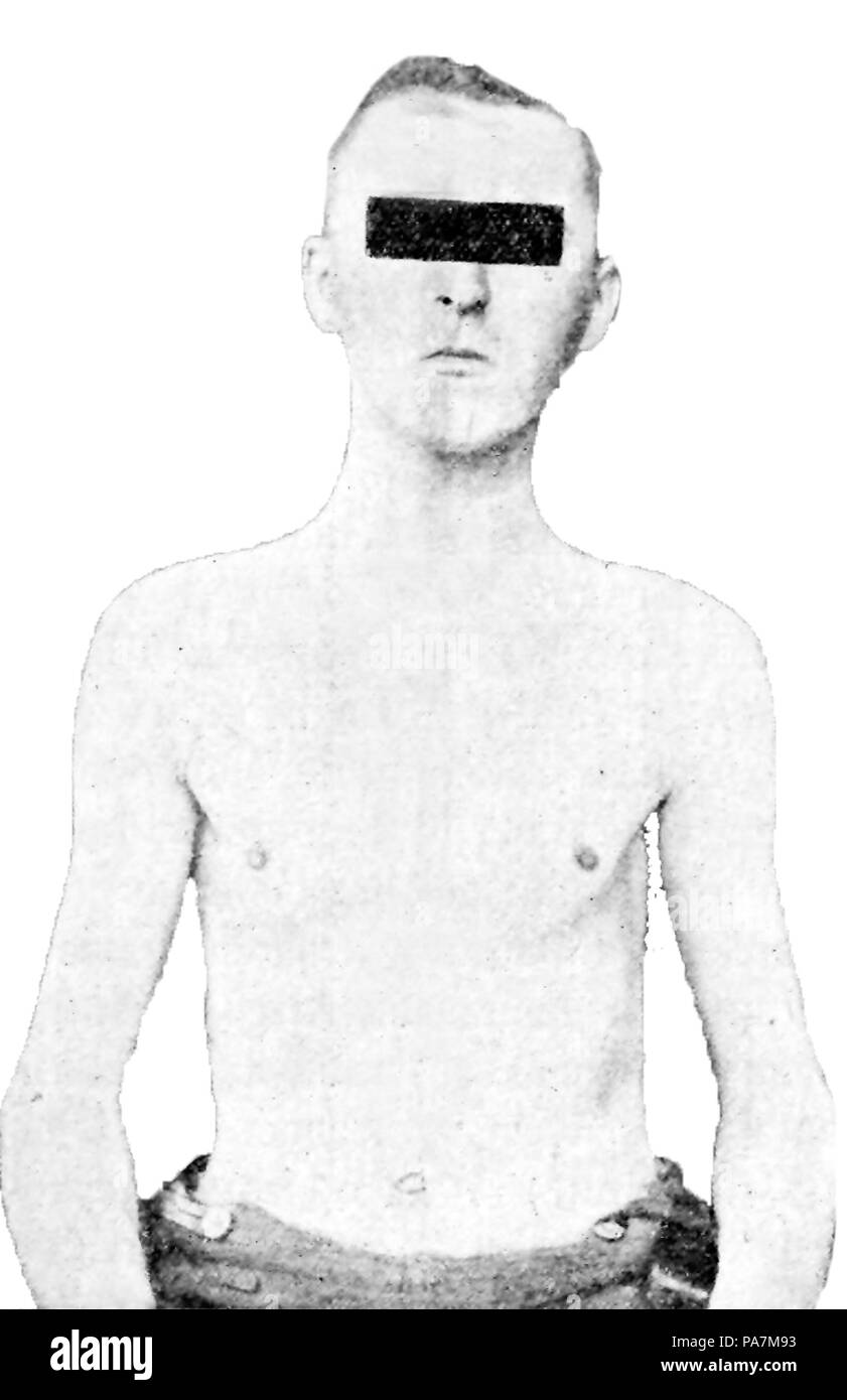 162 schizoïde asthénique Banque D'Images