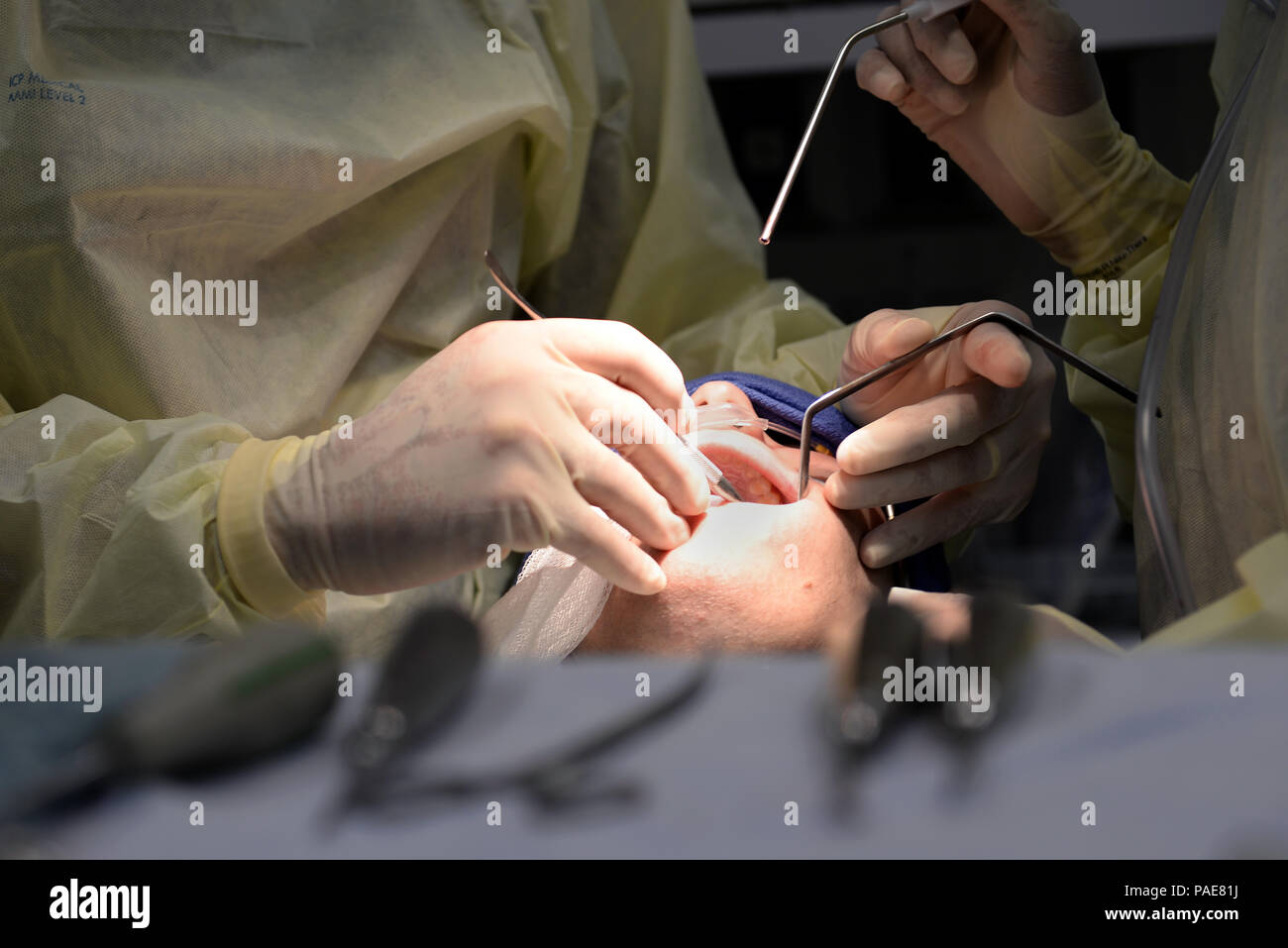 Les aviateurs de l'US Air Force assigné à la 633e Groupe médical, effectuer la chirurgie buccale à Langley Air Force Base, en Virginie, le 17 mars 2016. En plus de dents de sagesse dépose, Langley, les chirurgiens peuvent effectuer une chirurgie de la mâchoire de mesures correctives, l'apnée obstructive du sommeil, chirurgie de greffe osseuse, réparation de lacérations complexes de la tête et du cou et des biopsies de tissus mous de la face. (U.S. Air Force photo par un membre de la 1re classe Kaylee Dubois) Banque D'Images