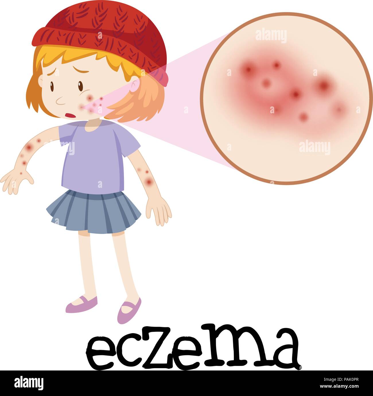 Jeune enfant avec l'eczéma illustration agrandie Illustration de Vecteur