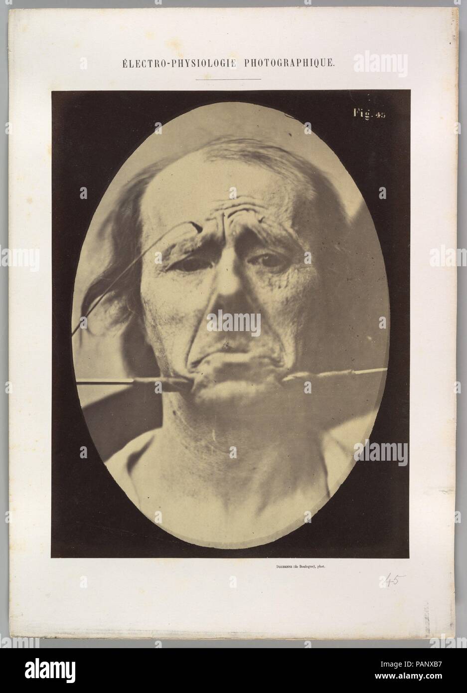 Figure 45 : La douleur et le désespoir. Artiste : Guillaume-Benjamin Duchenne de Boulogne-Amand (Français, 1806-1875), Adrien Tournachon (Français, 1825-1903). Dimensions : Image (ovale) : 28,6 × 20,4 cm (11 1/4 x 8 1/16 in.) Feuille : 29,8 × 22,9 cm (11 3/4 x 9 in.) Mont : 40,1 × 28,4 cm (15 × 13/16 11 3/16 po.). Date : 1856, imprimé en 1862. Musée : Metropolitan Museum of Art, New York, USA. Banque D'Images