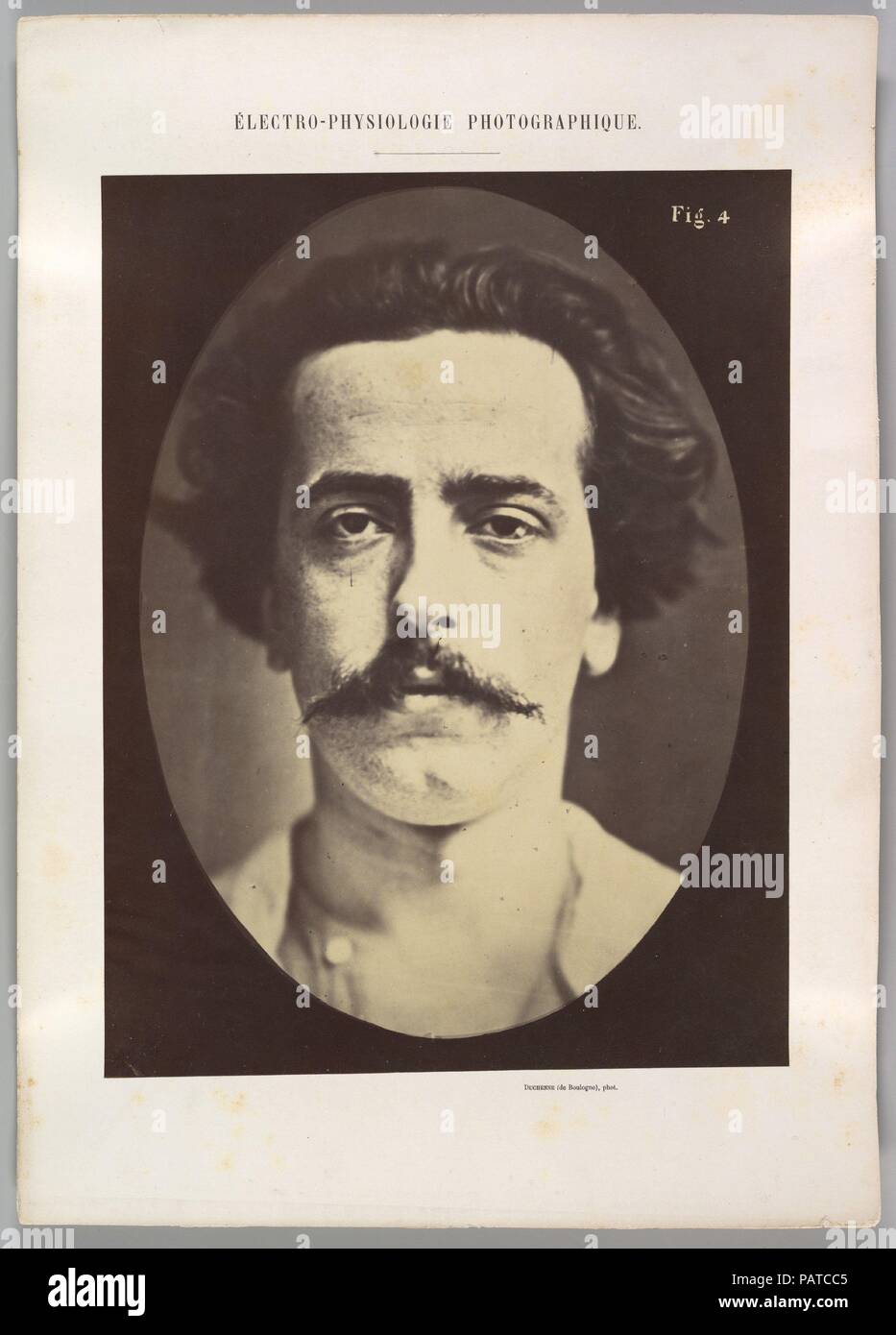 Figure 4 : le visage au repos d'un jeune homme. Artiste : Guillaume-Benjamin Duchenne de Boulogne-Amand (Français, 1806-1875), Adrien Tournachon (Français, 1825-1903). Dimensions : Image (ovale) : 28,5 × 20,3 cm (11 1/4 x 8 in.) feuille : 30 × 22,8 cm (11 13/16 x 9 in.) Mont : 40,1 × 28,6 cm (15 13/16 × 11 1/4 in.). Date : 1856, imprimé en 1862. Musée : Metropolitan Museum of Art, New York, USA. Banque D'Images