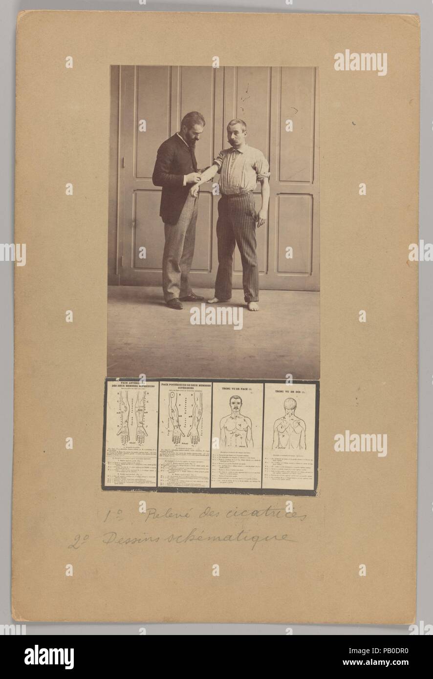 Notation de cicatrices, de schémas. Artiste : Alphonse Bertillon (Français, 1853-1914). Dimensions : Image (haut) : 6 in. × 4 1/8 in. (15,2 × 10,4 cm) (en bas) : 3/16 2 × 4 1/8 in. (5,6 x 10,5 cm) Mont : 11 × 3/4 7 3/4 in. (29,8 × 19,7 cm). Date : ca. 1893. Né dans une famille de scientifiques et des statisticiens, Bertillon a commencé sa carrière comme commis au bureau d'identification de la Préfecture de Police de Paris en 1879. Chargé de maintenir des dossiers de police fiable des délinquants, il a développé le premier système moderne de l'identification criminelle. Le système, qui est devenu connu comme être Banque D'Images