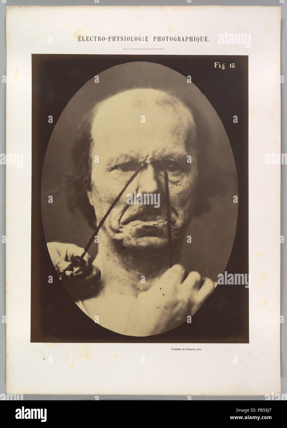 Figure 18 : l'agressivité, la méchanceté. Artiste : Guillaume-Benjamin Duchenne de Boulogne-Amand (Français, 1806-1875), Adrien Tournachon (Français, 1825-1903). Dimensions : Image (ovale) : 28,5 × 20,4 cm (11 1/4 x 8 1/16 in.) : feuille 29,9 × 22,6 cm (11 3/4 x 8 7/8 in.) Montage : 40 × 28,3 cm (15 3/4 x 11 1/8 in.). Date : 1856, imprimé en 1862. Musée : Metropolitan Museum of Art, New York, USA. Banque D'Images