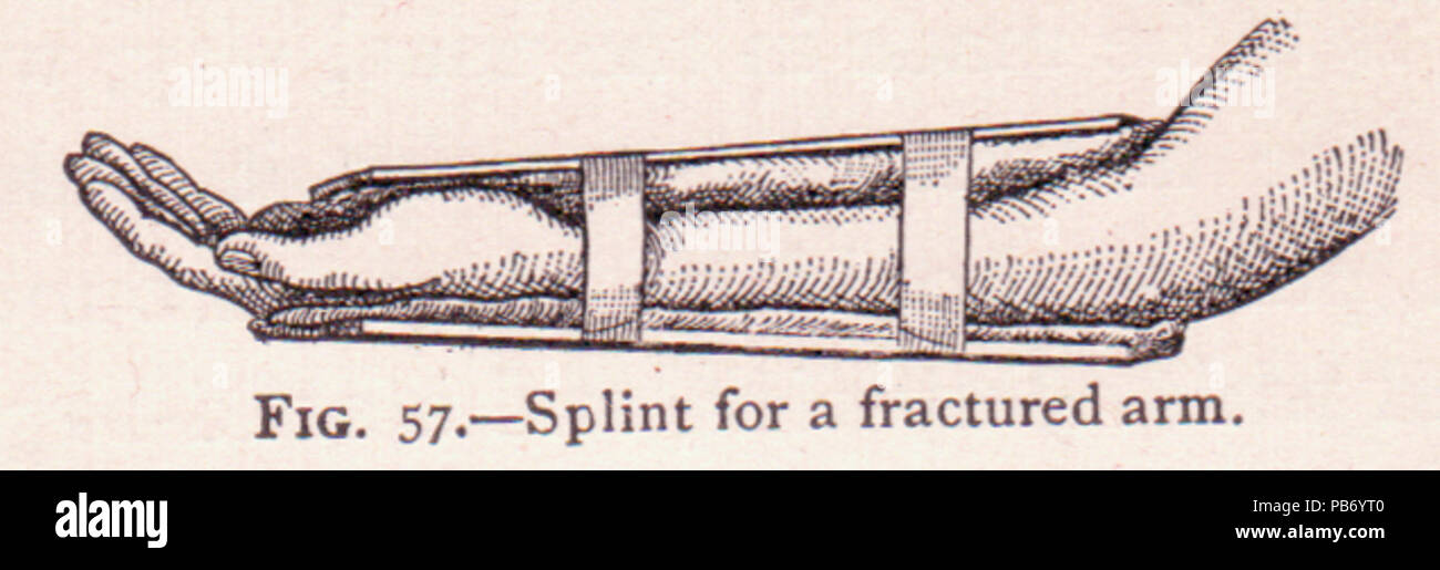https://c8.alamy.com/compfr/pb6yt0/l-eclisse-de-1559-pour-un-bras-fracture-pb6yt0.jpg