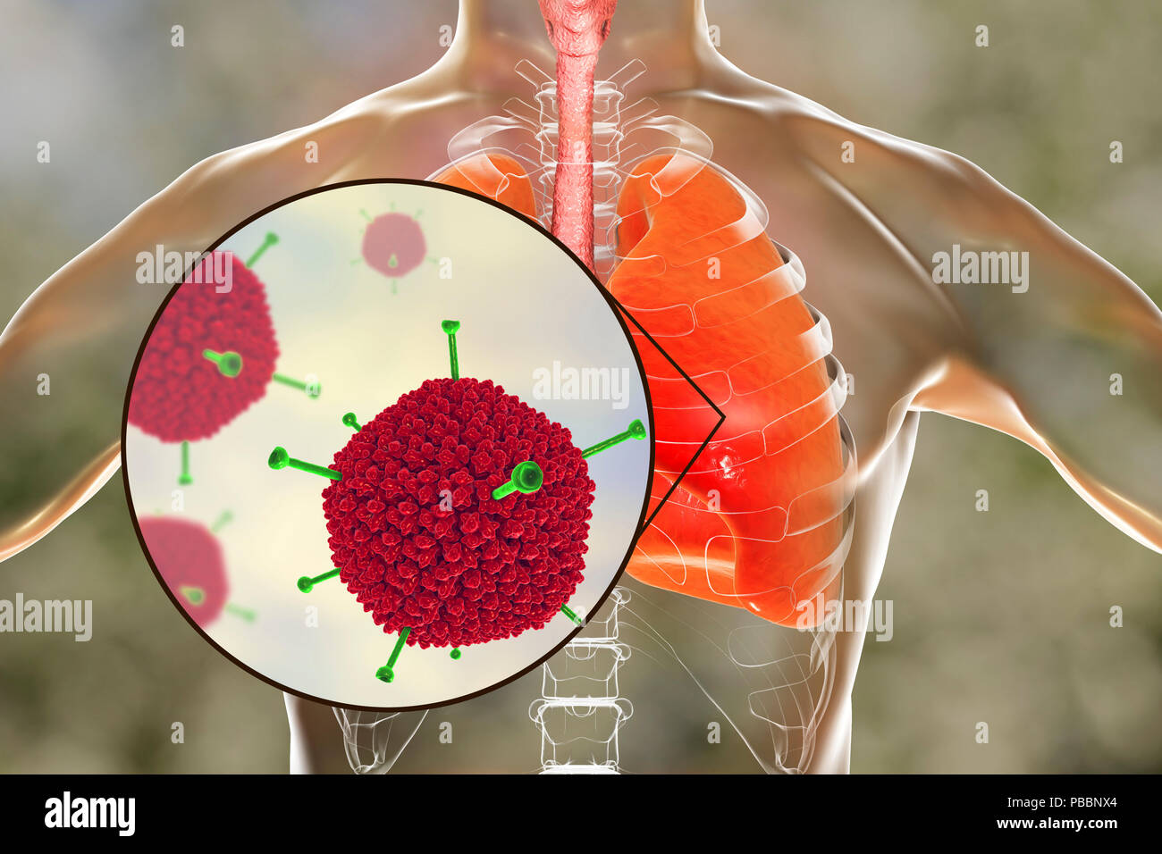 Les adénovirus infectent les poumons, l'illustration de l'ordinateur. Les adénovirus sont des virus à ADN qui infectent le plus fréquemment les voies respiratoires supérieures, des yeux et de l'intestin. Ils peuvent parfois causer une infection des voies respiratoires inférieures (pneumonie), en particulier chez les enfants et les patients immunodéprimés. Banque D'Images