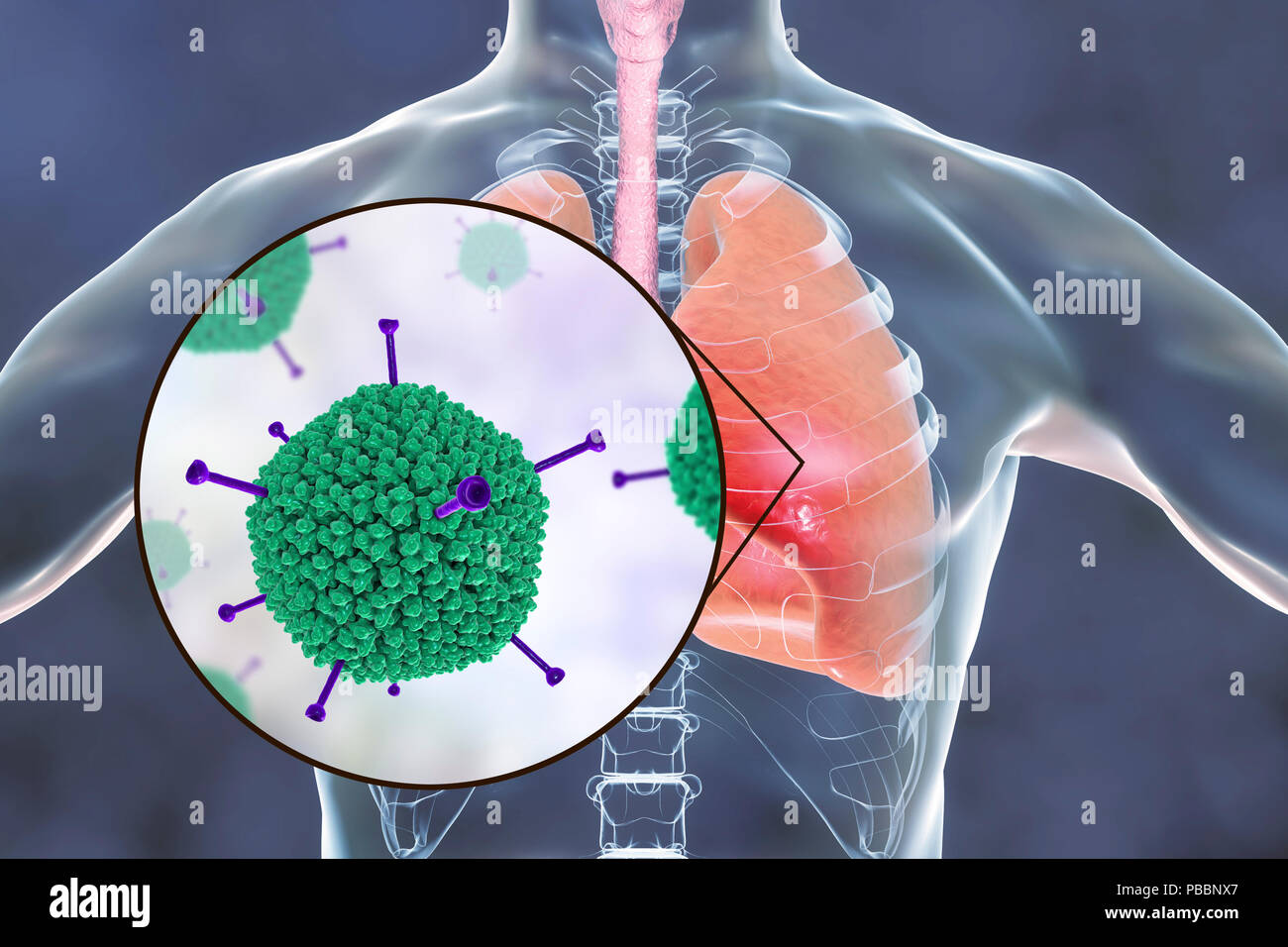 Les adénovirus infectent les poumons, l'illustration de l'ordinateur. Les adénovirus sont des virus à ADN qui infectent le plus fréquemment les voies respiratoires supérieures, des yeux et de l'intestin. Ils peuvent parfois causer une infection des voies respiratoires inférieures (pneumonie), en particulier chez les enfants et les patients immunodéprimés. Banque D'Images