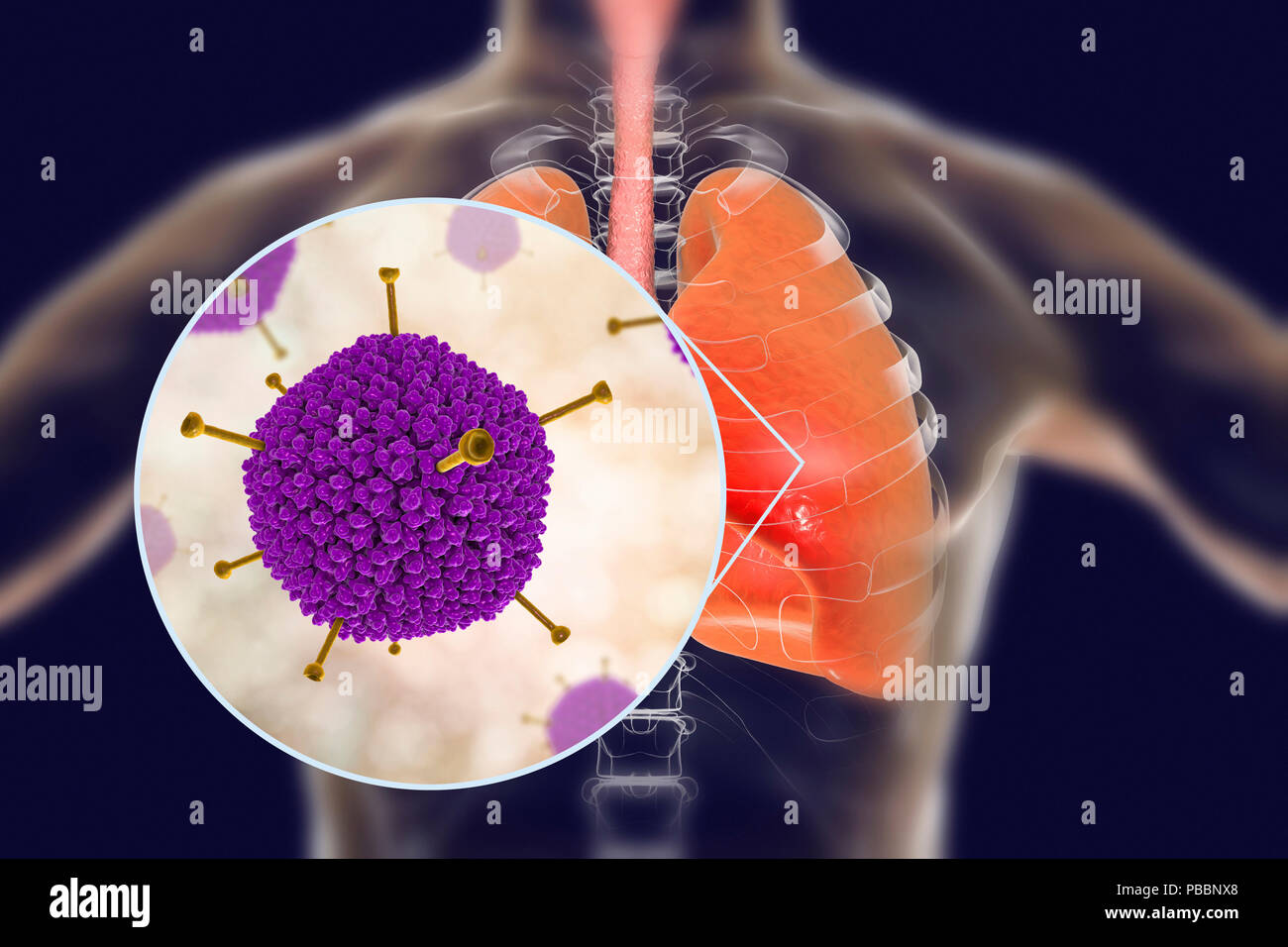 Les adénovirus infectent les poumons, l'illustration de l'ordinateur. Les adénovirus sont des virus à ADN qui infectent le plus fréquemment les voies respiratoires supérieures, des yeux et de l'intestin. Ils peuvent parfois causer une infection des voies respiratoires inférieures (pneumonie), en particulier chez les enfants et les patients immunodéprimés. Banque D'Images