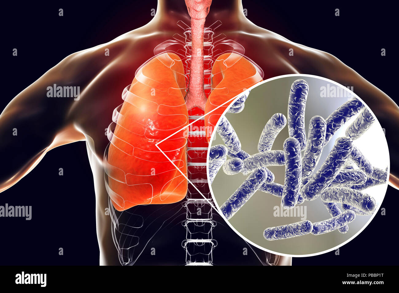 La maladie du légionnaire, ordinateur conceptuel illustration. La legionella pneumophila
