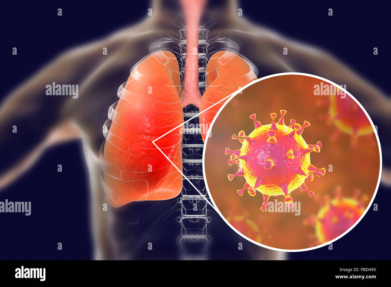 L'infection par le virus de mers de poumons, illustration conceptuelle. MERS (Middle East respiratory syndrome) est une maladie respiratoire virale causée par le coronavirus du MERS-associés (MERS-CoV). Anciennement connu sous le nouveau coronavirus, mers a été identifié pour la première fois en Arabie saoudite en 2012. La plupart des personnes infectées par MERS développer une maladie respiratoire aiguë sévère avec des symptômes de fièvre, de toux et l'essoufflement. Banque D'Images