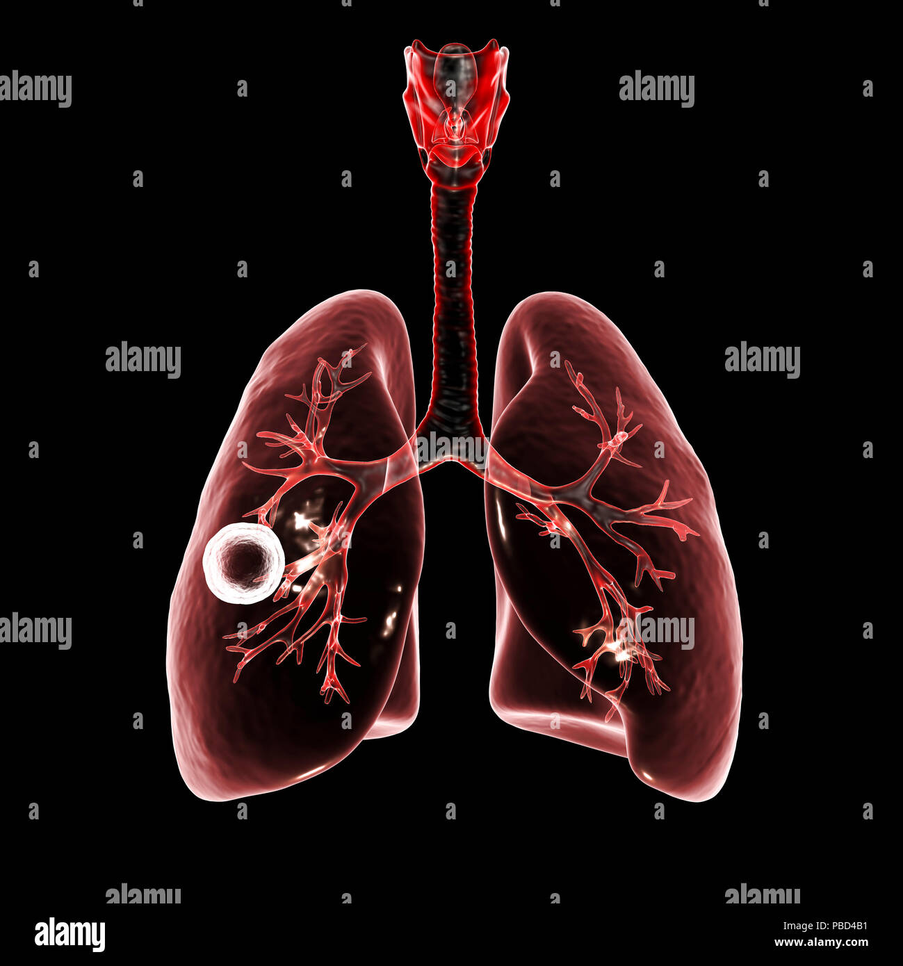 Tuberculose pulmonaire caverneux-fibreux. Illustration d'ordinateur montrant cavern (cavité) dans le poumon droit avec une couche fibreuse dans son mur. Banque D'Images
