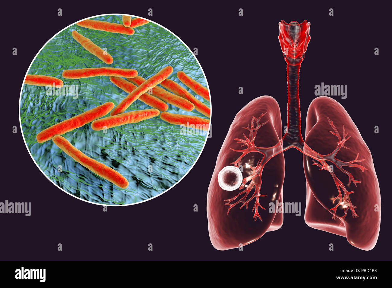 Tuberculose pulmonaire caverneux-fibreuse et vue rapprochée de la bactérie Mycobacterium tuberculosis, l'agent étiologique de la tuberculose. Illustration d'ordinateur montrant cavern (cavité) dans le poumon droit avec une couche fibreuse dans son mur. Banque D'Images