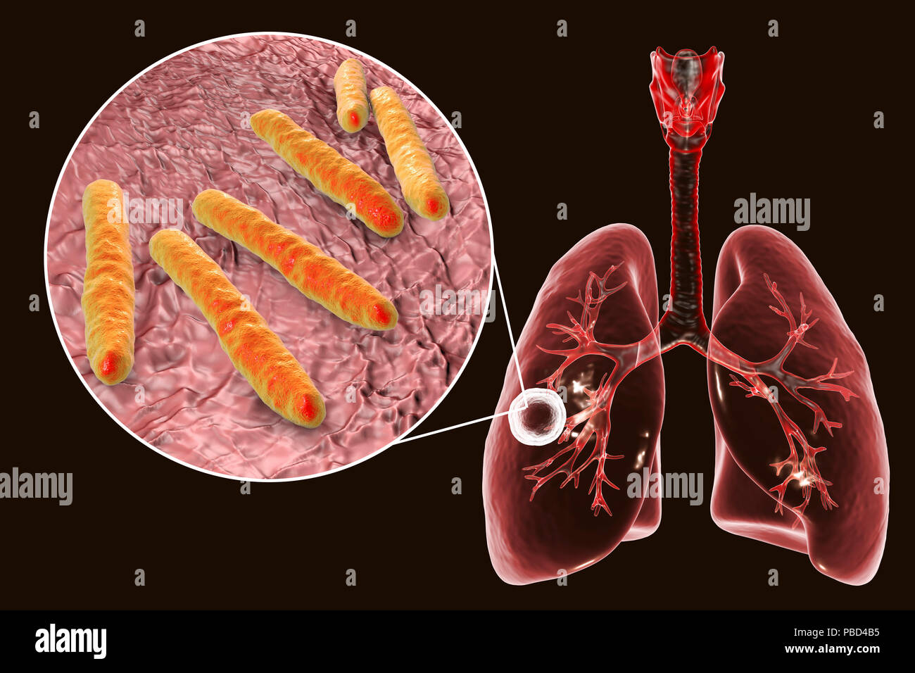 Tuberculose pulmonaire caverneux-fibreuse et vue rapprochée de la bactérie Mycobacterium tuberculosis, l'agent étiologique de la tuberculose. Illustration d'ordinateur montrant cavern (cavité) dans le poumon droit avec une couche fibreuse dans son mur. Banque D'Images
