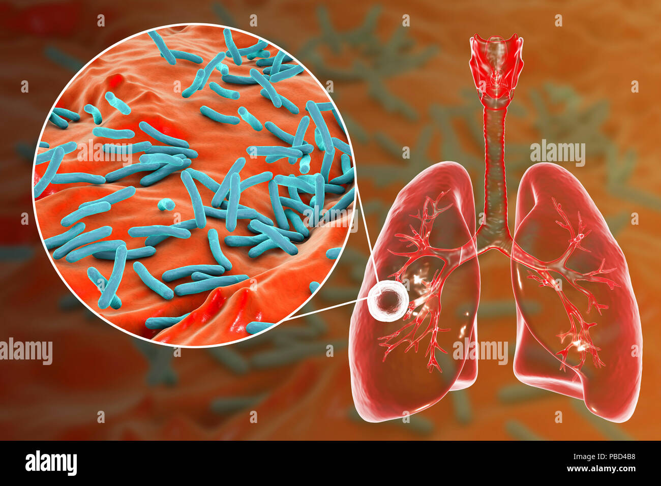 Tuberculose pulmonaire caverneux-fibreuse et vue rapprochée de la bactérie Mycobacterium tuberculosis, l'agent étiologique de la tuberculose. Illustration d'ordinateur montrant cavern (cavité) dans le poumon droit avec une couche fibreuse dans son mur. Banque D'Images