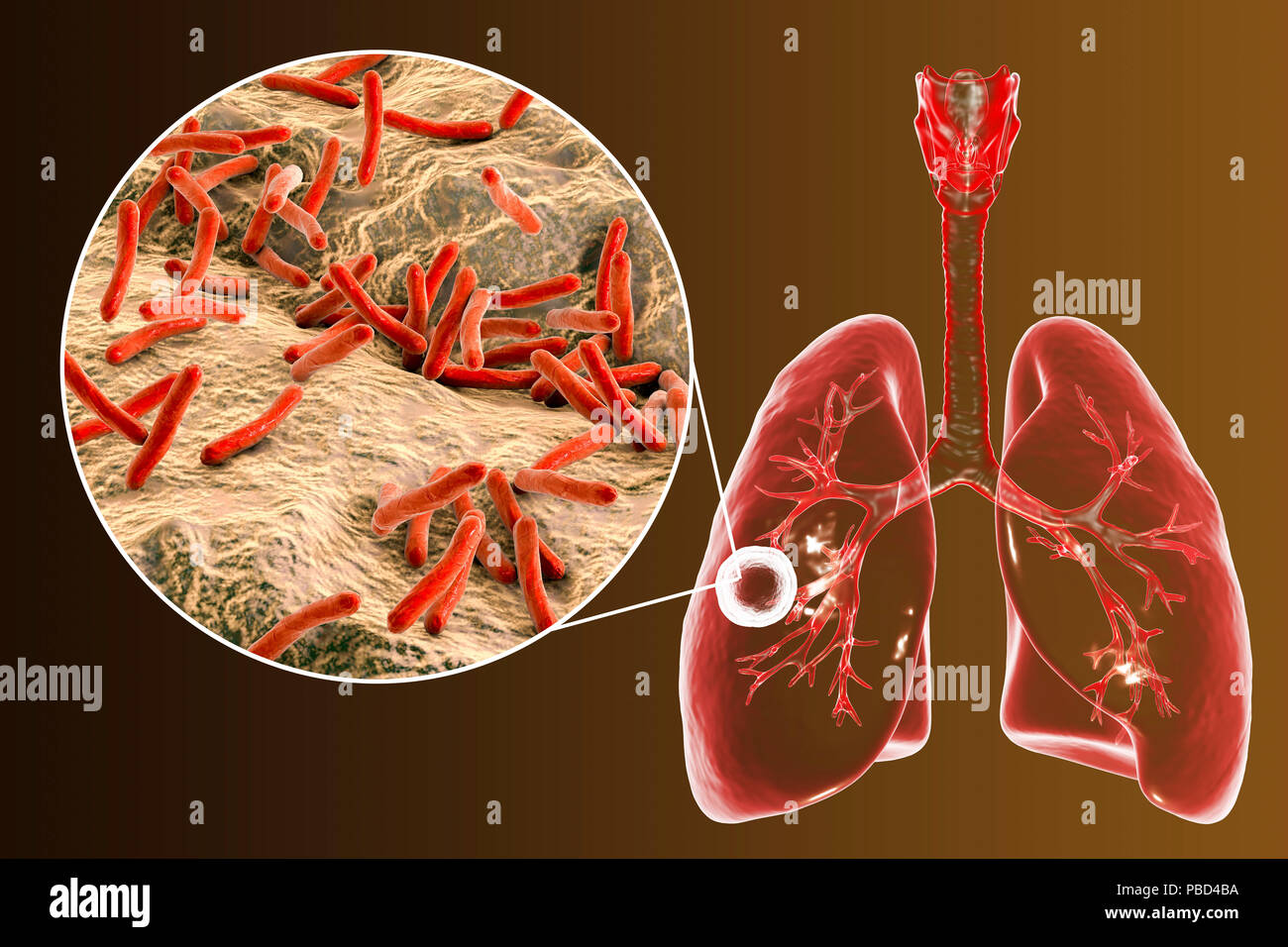 Tuberculose pulmonaire caverneux-fibreuse et vue rapprochée de la bactérie Mycobacterium tuberculosis, l'agent étiologique de la tuberculose. Illustration d'ordinateur montrant cavern (cavité) dans le poumon droit avec une couche fibreuse dans son mur. Banque D'Images
