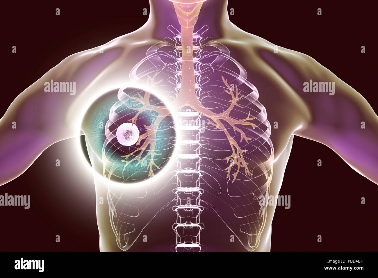 Traitement et prévention de la tuberculose pulmonaire, l'illustration de l'ordinateur conceptuel. Caverne en surbrillance (cavité) dans le poumon droit avec une couche fibreuse dans son mur. Banque D'Images