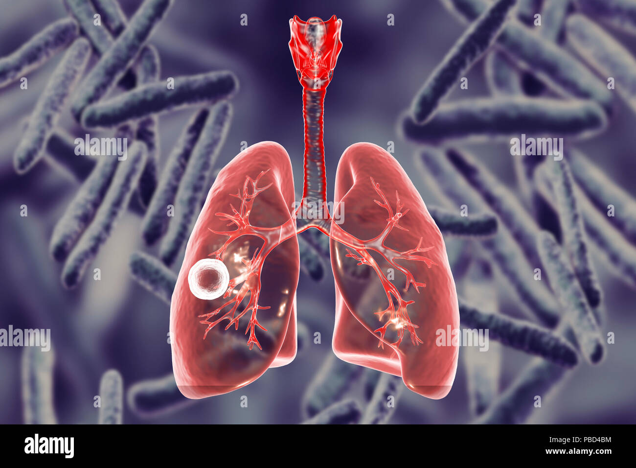 Tuberculose pulmonaire caverneux-fibreux. Illustration d'ordinateur montrant cavern (cavité) dans le poumon droit avec une couche fibreuse dans son mur. Arrière-plan de l'image représente l'illustration de la bactérie Mycobacterium tuberculosis, l'agent étiologique de la tuberculose. Banque D'Images