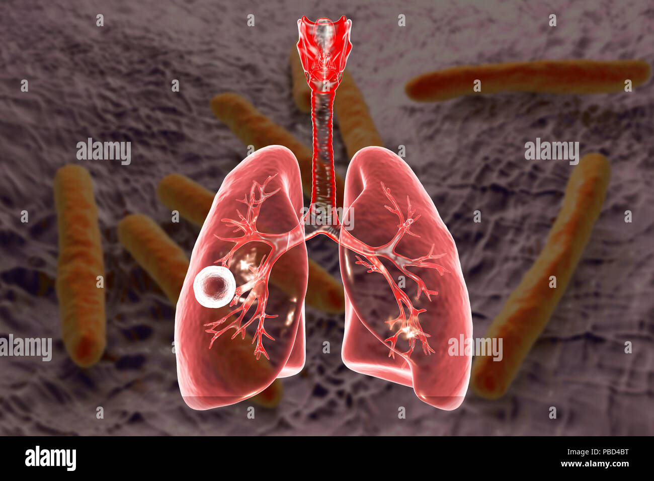 Tuberculose pulmonaire caverneux-fibreux. Illustration d'ordinateur montrant cavern (cavité) dans le poumon droit avec une couche fibreuse dans son mur. Arrière-plan de l'image représente l'illustration de la bactérie Mycobacterium tuberculosis, l'agent étiologique de la tuberculose. Banque D'Images