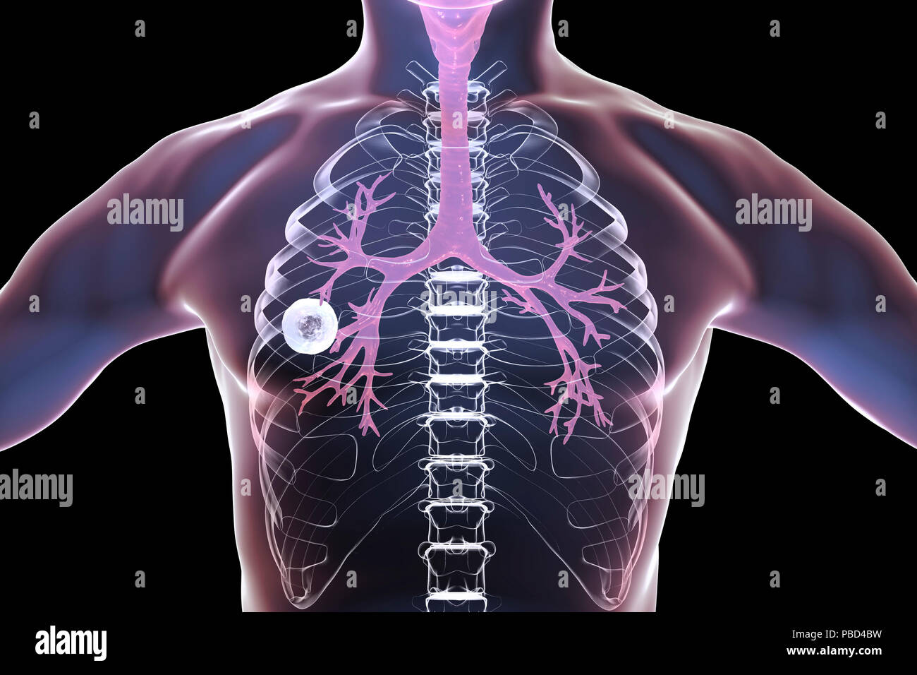 Tuberculose pulmonaire caverneux-fibreux. Illustration d'ordinateur montrant cavern (cavité) dans le poumon droit avec une couche fibreuse dans son mur. Banque D'Images