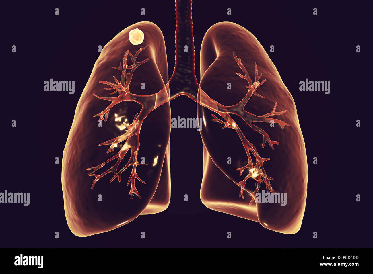 Tuberculose-infection secondaire. Illustration d'ordinateur solide de petite taille masse nodulaire situé dans le lobe supérieur du poumon droit près de l'apex pulmonaire. Banque D'Images