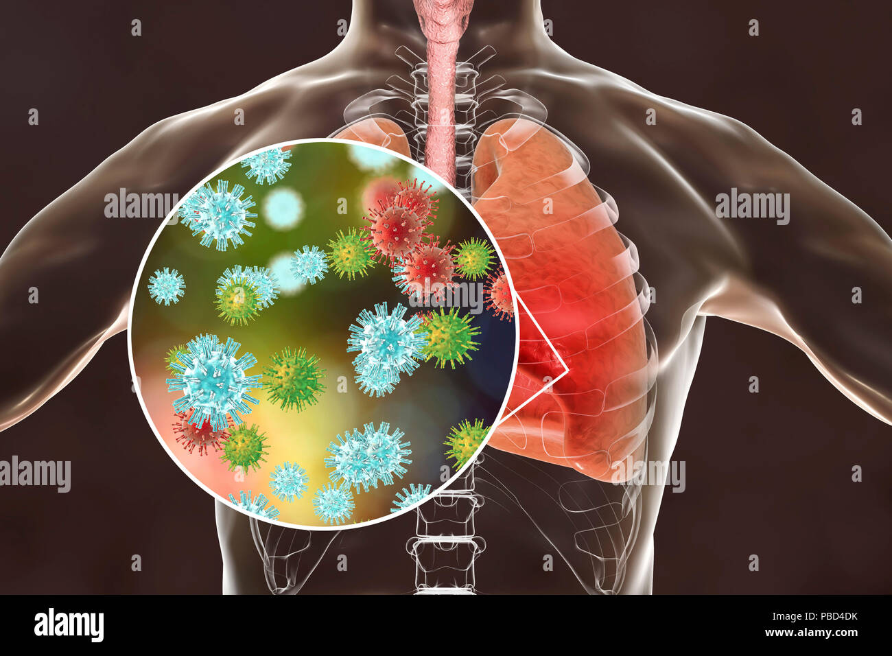 La pneumonie virale, illustration conceptuelle. Les poumons et la vue rapprochée des virus, les agents pathogènes de la pneumonie. La pneumonie peut être causée par plusieurs types de virus, y compris l'Influenza, MERS, SRAS, adénovirus et autres. Banque D'Images
