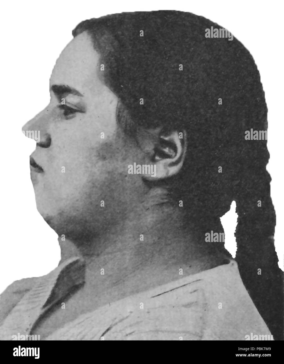 1295 pubertial schizophrène faible d'esprit et de l'obésité, l'âge de 19 ans. Profile Banque D'Images