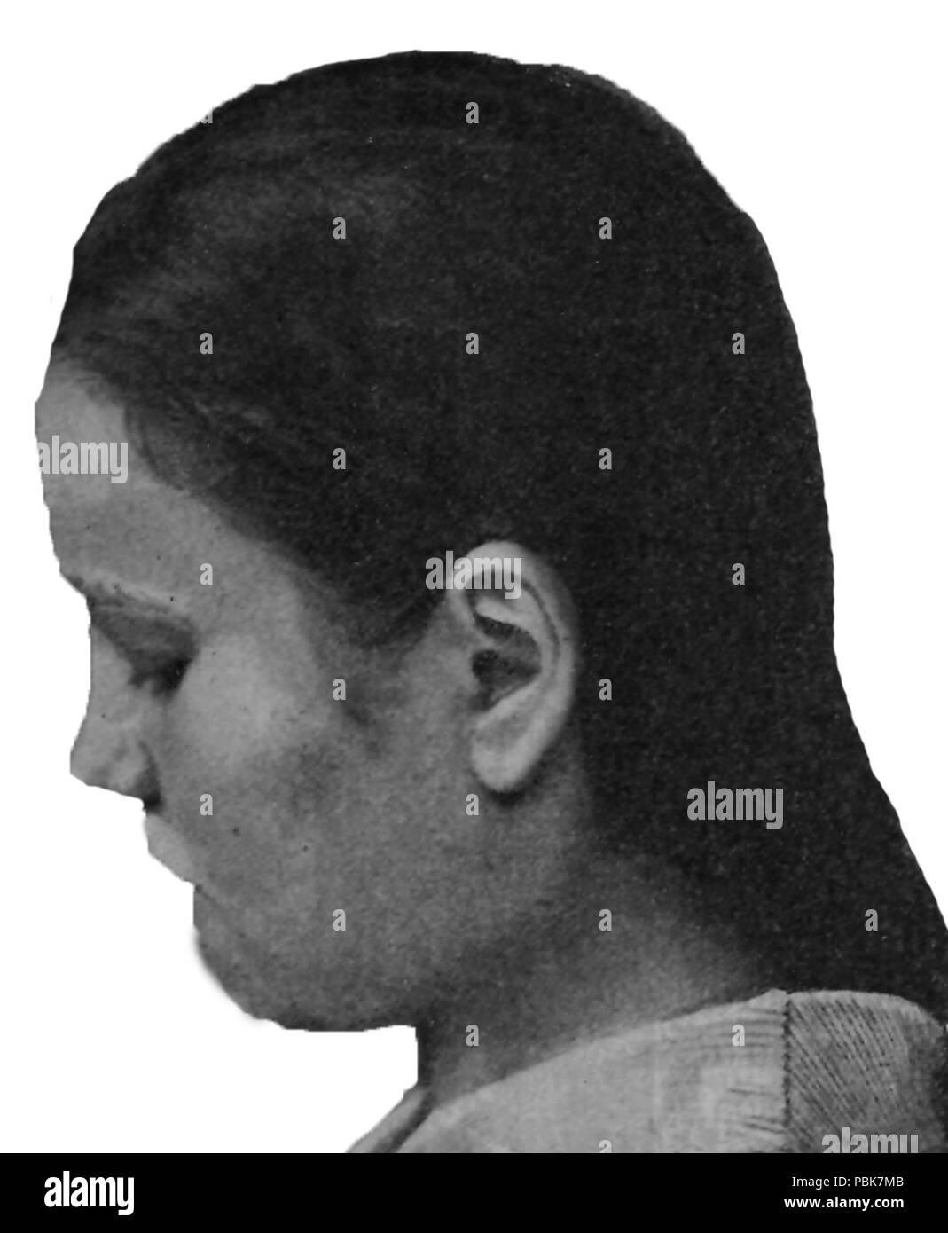 1310 schizophrène grave l'idiotie, l'âge de 19 ans. Profile Banque D'Images