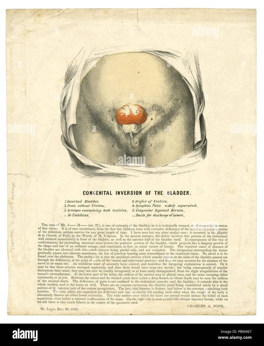 789 l'illustre l'affiche de la médecine, imprimé, montrant les effets de l'Inversion congénitale de la vessie, le 20 décembre 1848 Banque D'Images
