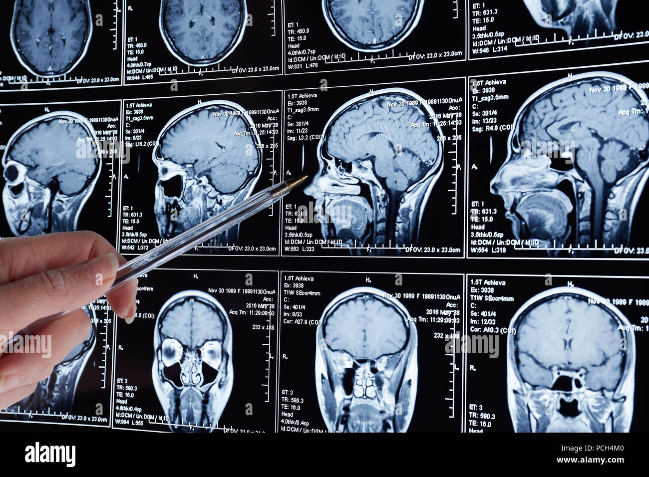 Analyse par résonance magnétique du cerveau. L'IRM scanner de la tête — free download