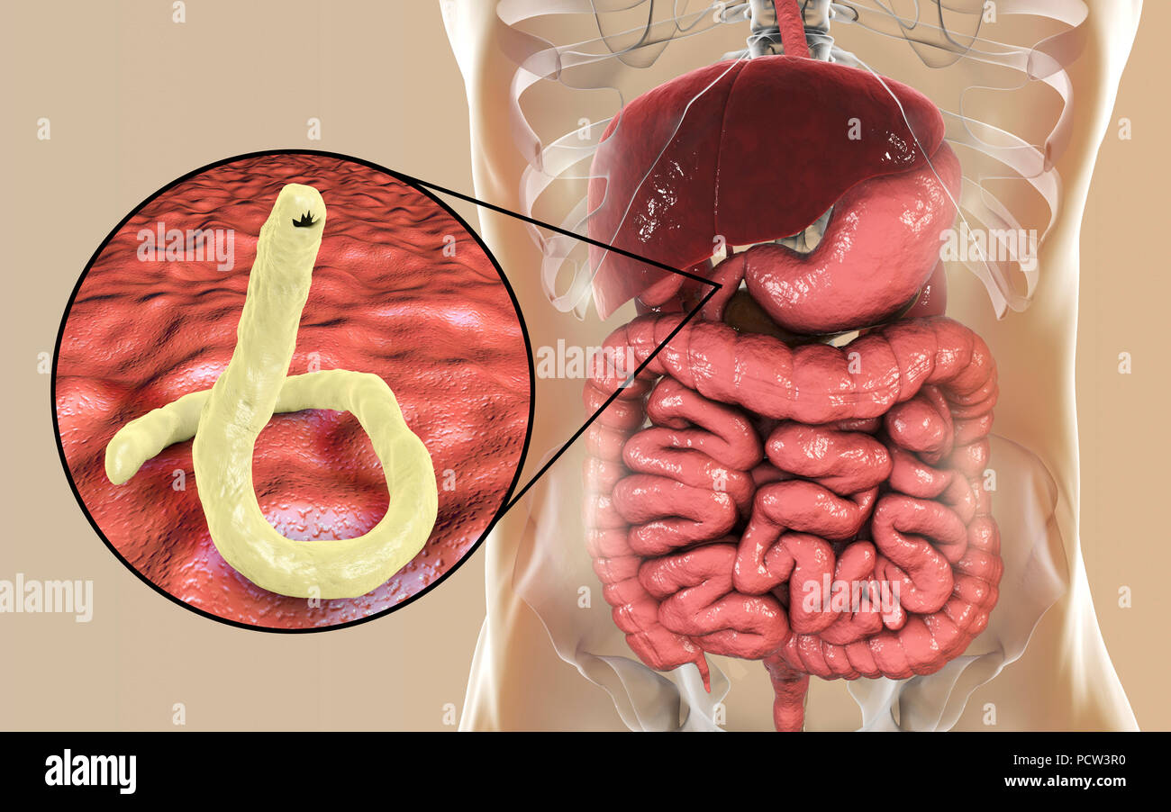 Illustration De L Ordinateur De L Ankylostome Parasite Ancylostoma Duodenale Dans L Intestin Grele C Est L Une Des Causes Les Plus Courantes De L Ankylostomiase Infestation Dans L Homme En Particulier Dans Des Regions Comme L Afrique Du Nord
