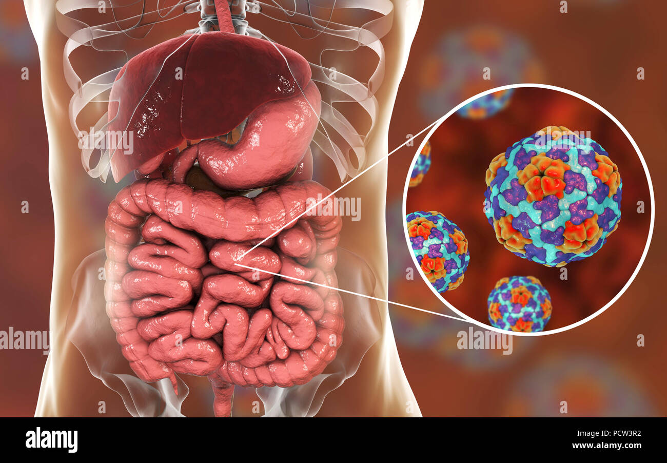 L'hépatite A virus qui infectent l'intestin, de l'illustration. L'hépatite A est transmise par la nourriture ou les boissons contaminées. Les symptômes comprennent la grippe-comme des symptômes de fièvre et de maladie, ainsi qu'un ictère. Banque D'Images