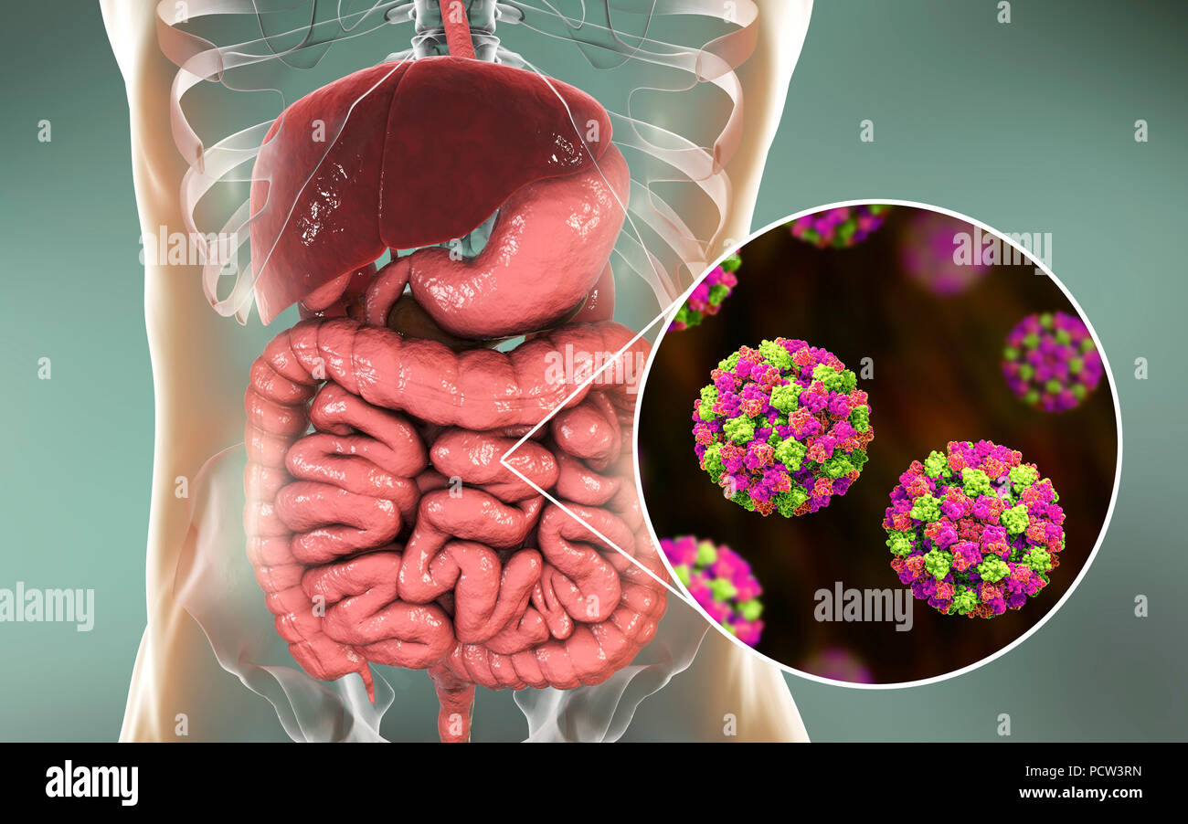 L'infection à norovirus, illustration de l'ordinateur. Le norovirus est un genre d'ARN (acide ribonucléique) virus (de la famille des Caliciviridae), qui sont responsables d'environ la moitié de tous les cas de gastro-entérite dans le monde entier. La maladie se caractérise par des nausées, vomissements, diarrhée et douleurs abdominales. La diarrhée résulte en une perte de liquide et de la déshydratation, qui peut entraîner la mort chez les jeunes, les personnes âgées et les personnes immunodéprimées si elle n'est pas traitée rapidement. Banque D'Images