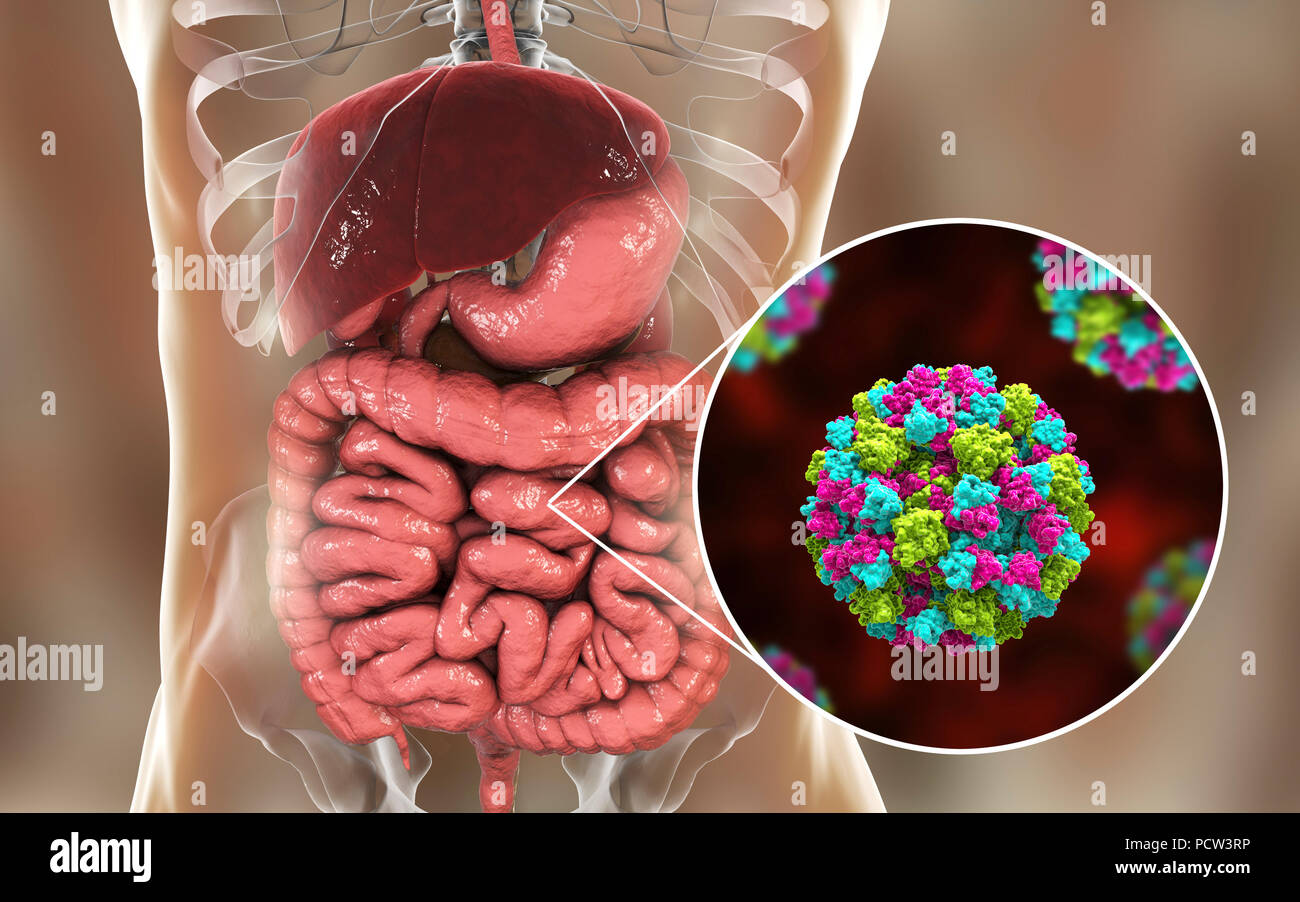 L'infection à norovirus, illustration de l'ordinateur. Le norovirus est un genre d'ARN (acide ribonucléique) virus (de la famille des Caliciviridae), qui sont responsables d'environ la moitié de tous les cas de gastro-entérite dans le monde entier. La maladie se caractérise par des nausées, vomissements, diarrhée et douleurs abdominales. La diarrhée résulte en une perte de liquide et de la déshydratation, qui peut entraîner la mort chez les jeunes, les personnes âgées et les personnes immunodéprimées si elle n'est pas traitée rapidement. Banque D'Images