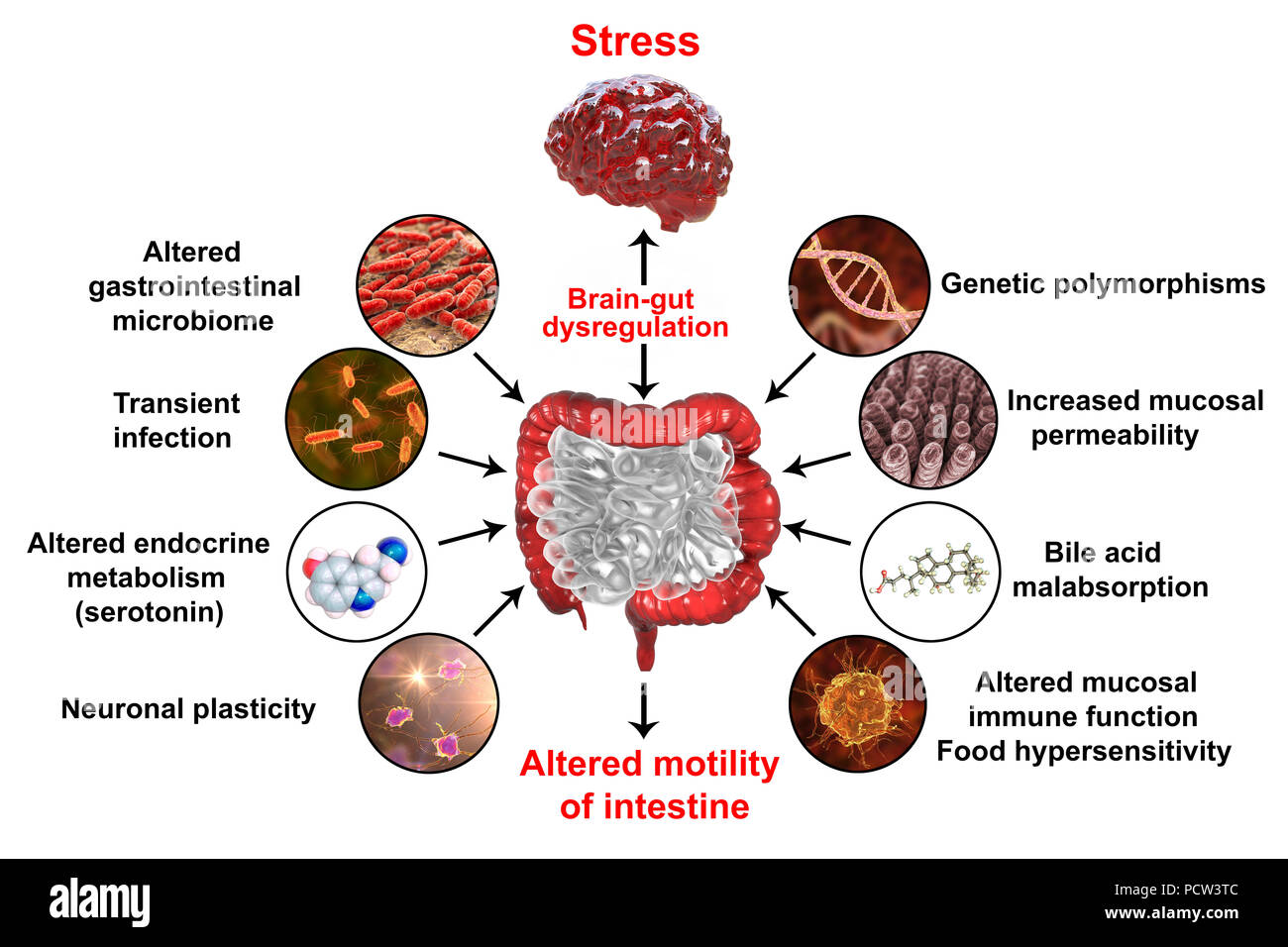 Le syndrome du côlon irritable,physiopathologie.Illustration d'un système  digestif souffrant du syndrome du côlon irritable (SCI).IBS est également  connu sous le nom de côlon spastique ou syndrome du côlon irritable.Il  provoque des douleurs