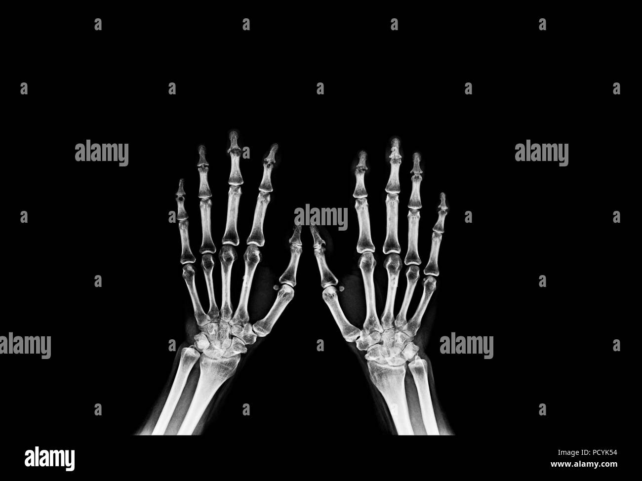Main et des doigts x-ray image Banque D'Images