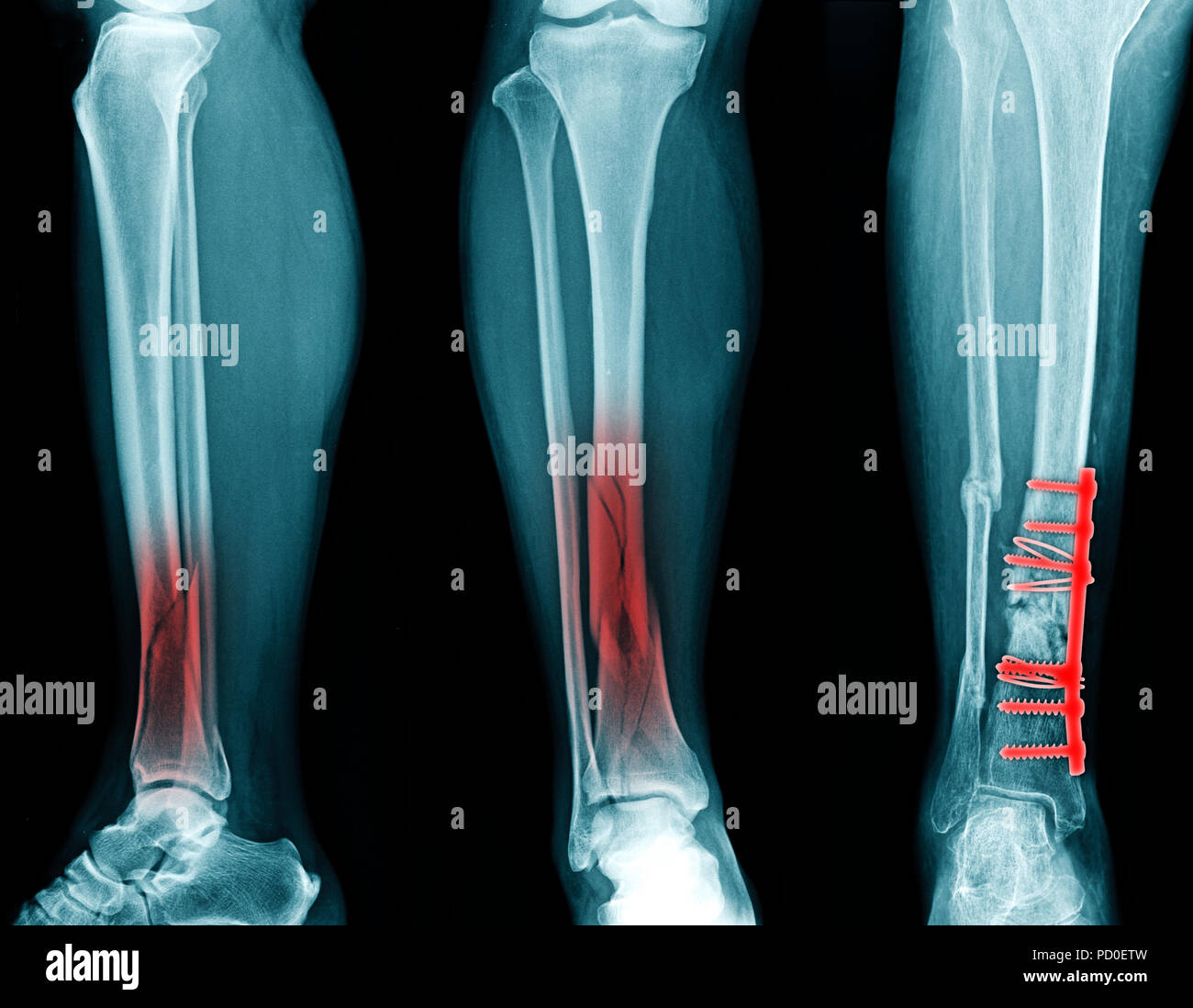 Fracture fixation Banque de photographies et d’images à haute résolution Alamy