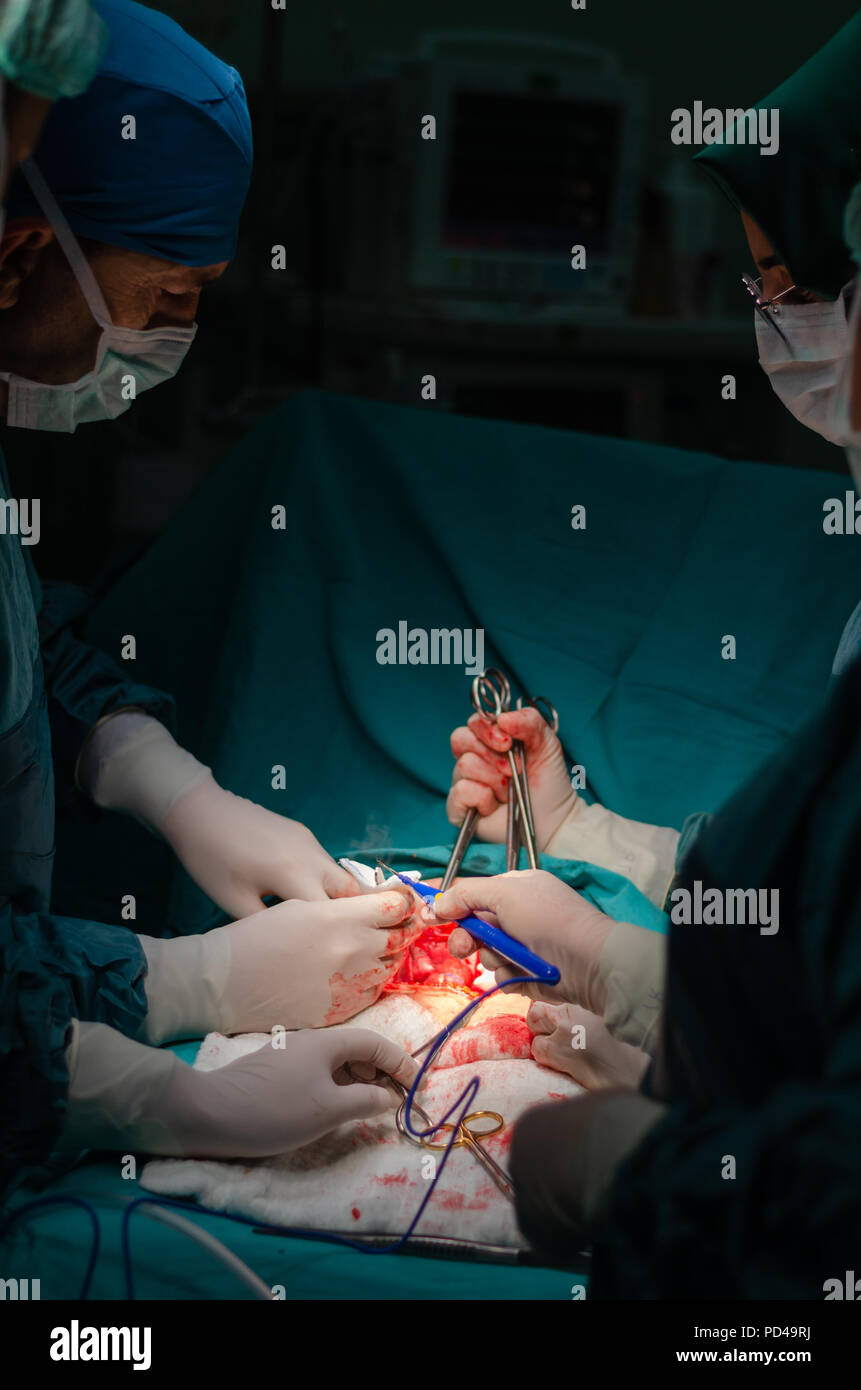 Utilisation de la cautérisation pour arrêter le saignement pendant la chirurgie hystérectomie Banque D'Images